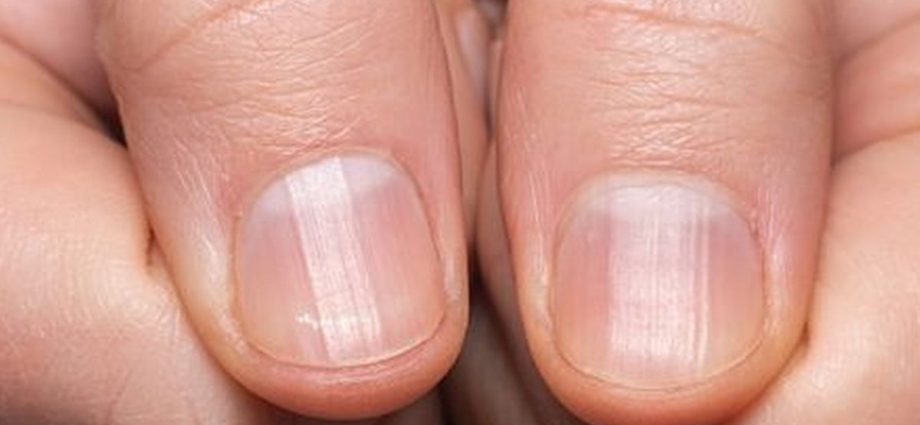 Staafvormige vingers zijn een ongebruikelijk symptoom van longkanker en leverziekte. Let op de vorm van de nagels