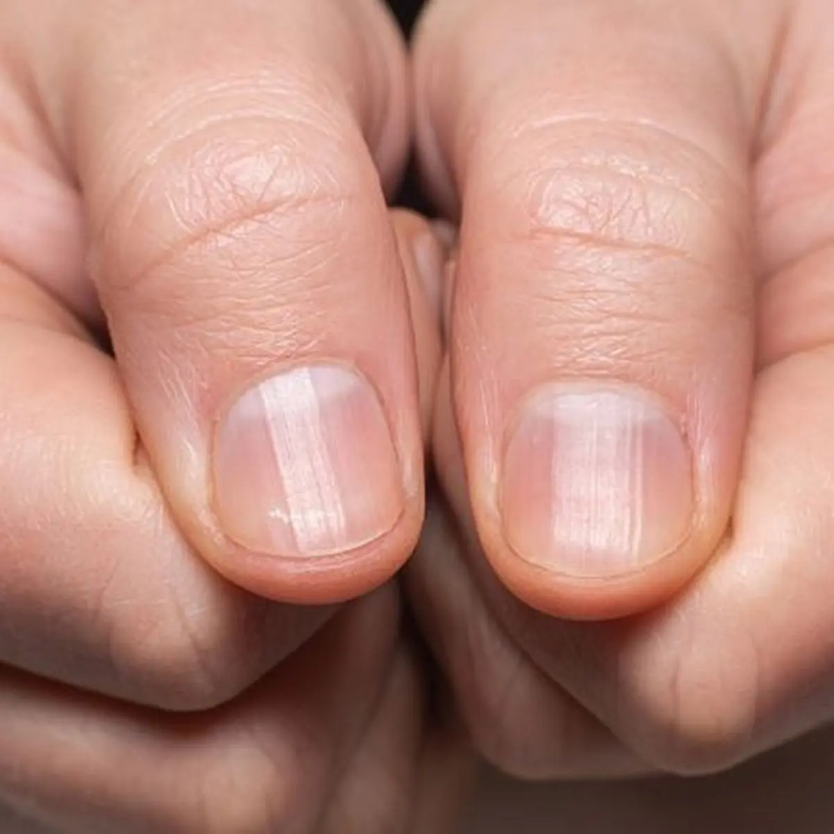 Rod-shaped fingers are an unusual symptom of lung cancer and liver disease. Pay attention to the shape of the nails