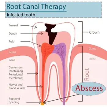 Root canal treatment &#8211; course, indications, price. Does root canal treatment hurt?