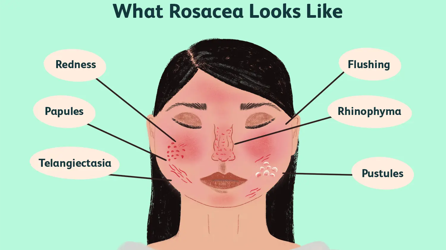 Rosacea &#8211; causes, symptoms, treatment. How does rosacea work and how do you recognize it? WE EXPLAIN