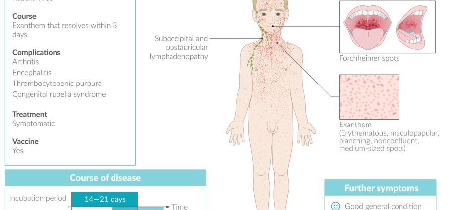 Rubella &#8211; hatching period, symptoms, complications