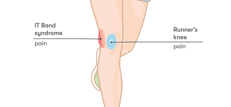 Runner&#8217;s knee &#8211; causes, symptoms, diagnosis, treatment