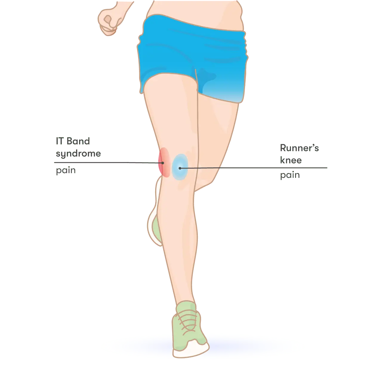 Runner&#8217;s knee &#8211; causes, symptoms, diagnosis, treatment