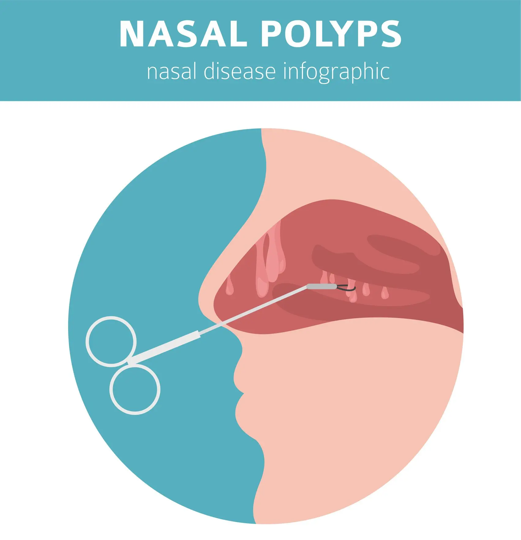 Runny nose &#8211; types, treatment and complications [WE EXPLAIN]