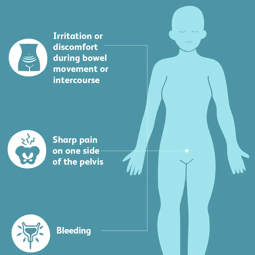 Rupture of the ovarian cyst