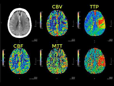 Safer perfusion computed tomography