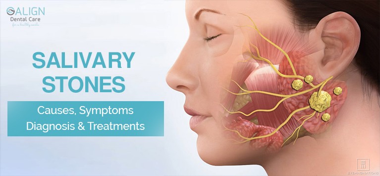 Salivary Gland Stones Causes Symptoms And Treatment Of Salivary Glands Healthy Food Near Me