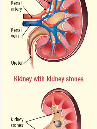 Sand in the kidneys &#8211; what is the risk? Pain can be hard to bear [EXPLAIN]