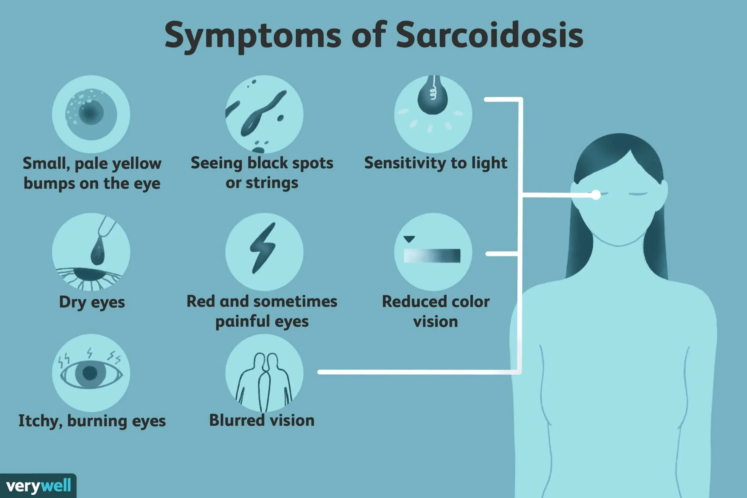 Sarcoidosis &#8211; causes, symptoms, diagnosis, complications. How is sarcoidosis treated?