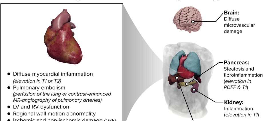 SARS-CoV-2 coronavirus infection can damage heart even in people with mild COVID-19 symptoms