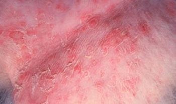 Scabies (scab, scab, sarcoptic mange) in pigs: treatment, symptoms, photos