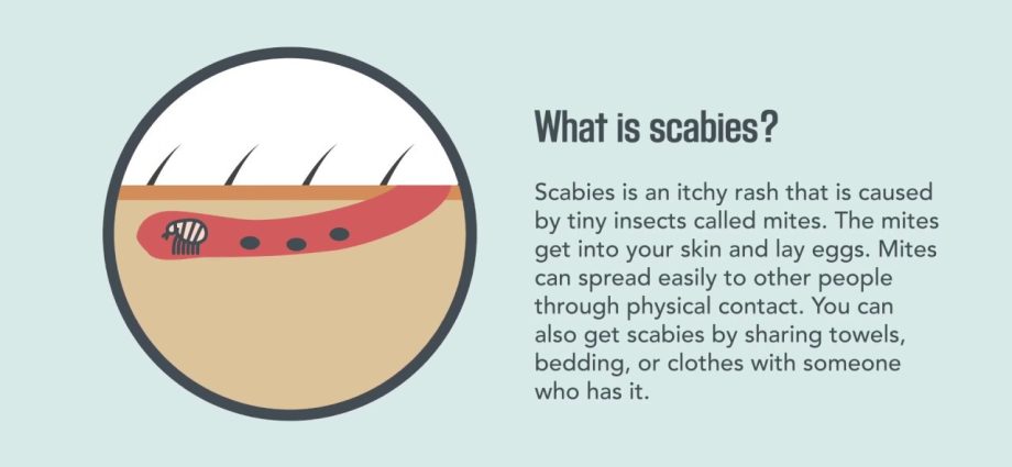 Scabies &#8211; Symptoms and Treatment