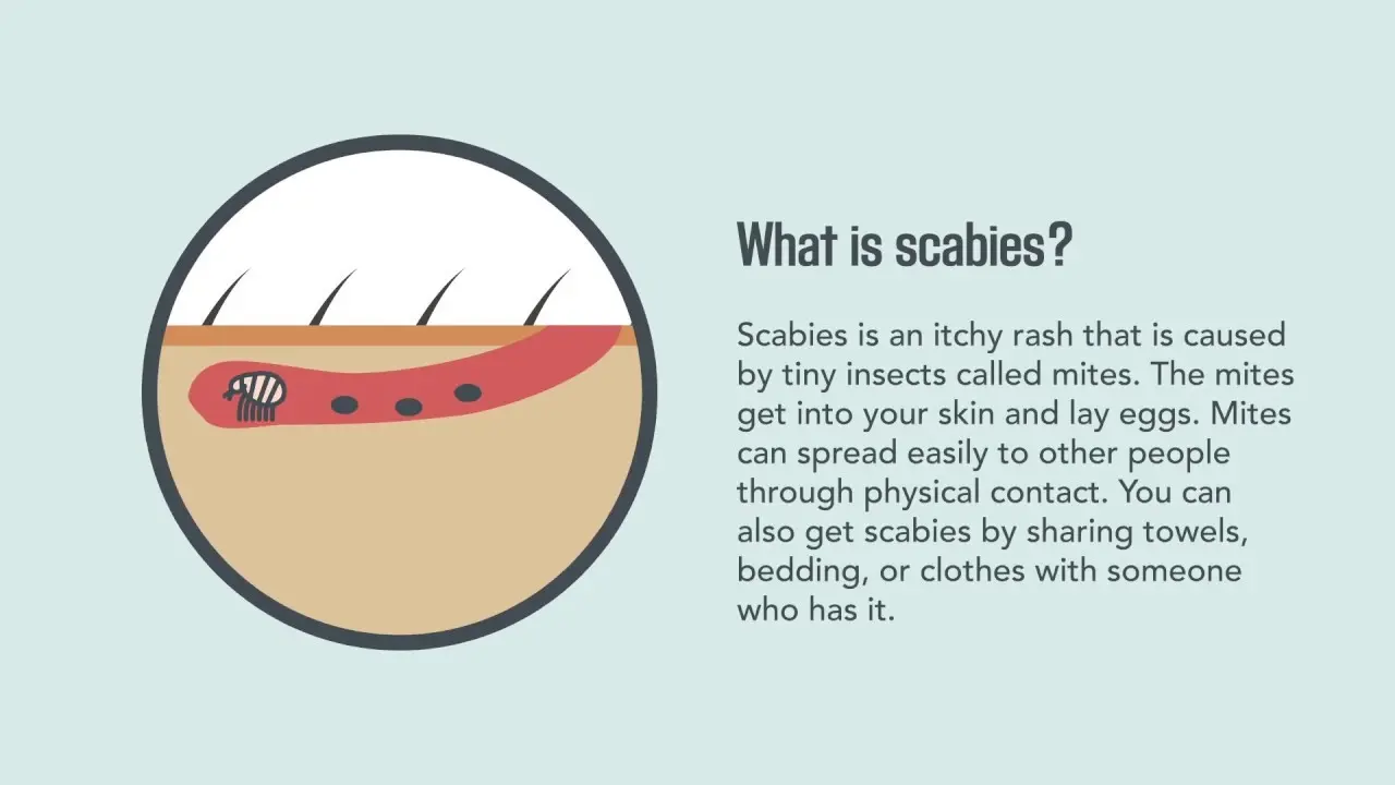 Scabies &#8211; Symptoms and Treatment