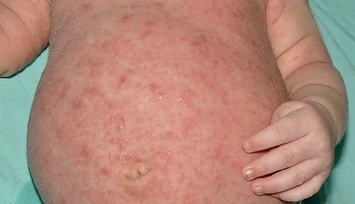 Scabies &#8211; symptoms, treatment, causes and photos. What does scabies look like?