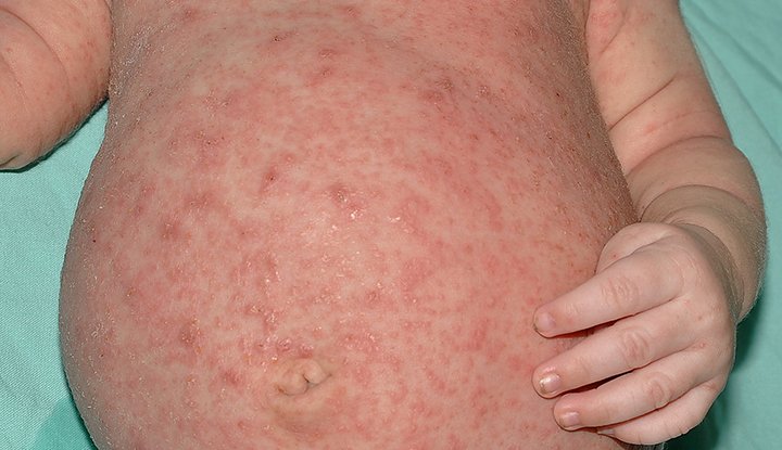 Scabies &#8211; What Should You Know About This Contagious Disease?