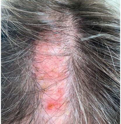 Scalp problems. Psoriasis, atopic dermatitis, mycosis