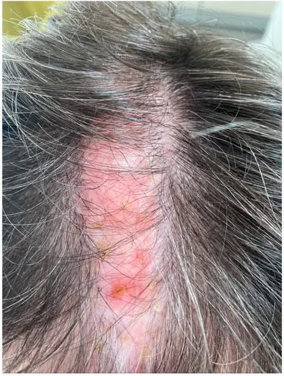 Scalp problems. Psoriasis, atopic dermatitis, mycosis