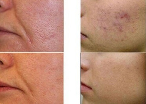 Scar removal &#8211; preparations, laser scar removal