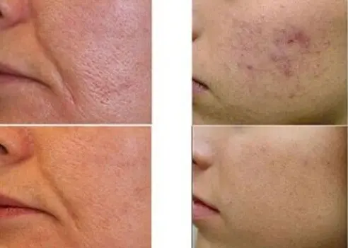 Scar removal &#8211; preparations, laser scar removal