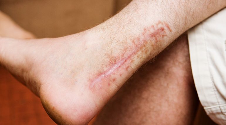 Scars &#8211; what do you need to know about them and how to care for them?