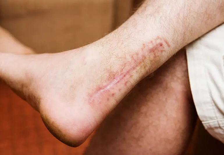 Scars &#8211; what do you need to know about them and how to care for them?