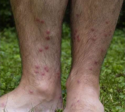 Schistosomal Dermatitis &#8211; Symptoms and Treatment