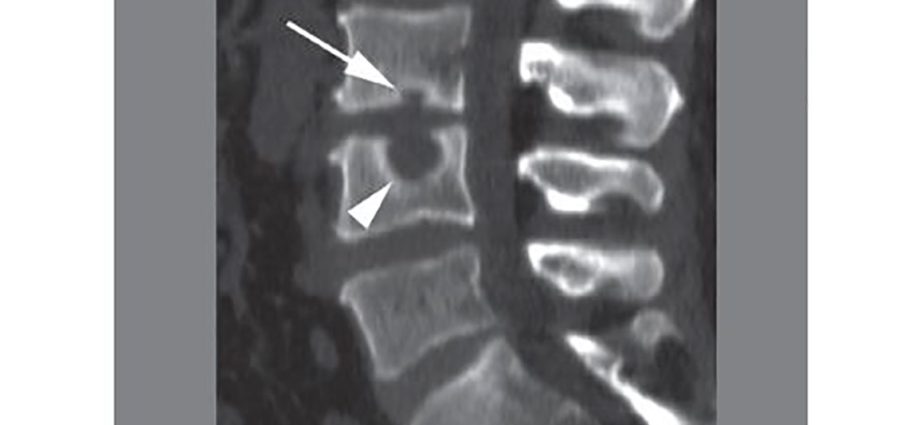 Schmorl nodules &#8211; what are they? Symptoms and treatment of Schmorl nodules