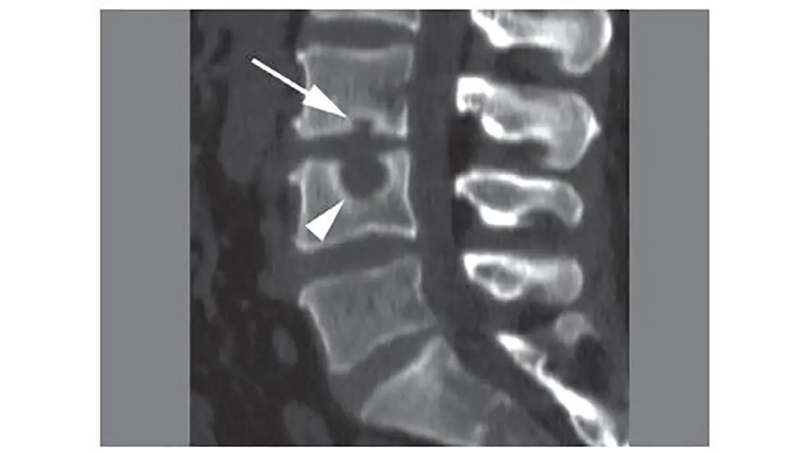 Schmorl nodules &#8211; what are they? Symptoms and treatment of Schmorl nodules