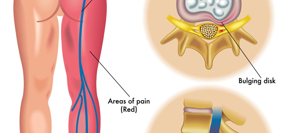 Sciatica &#8211; causes, symptoms, treatment [EXPLAINED]