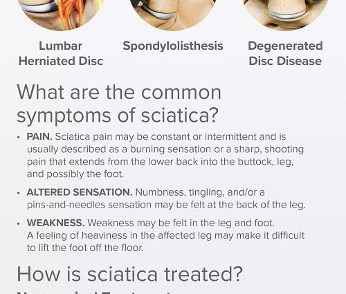 Sciatica in pregnancy &#8211; symptoms, treatment