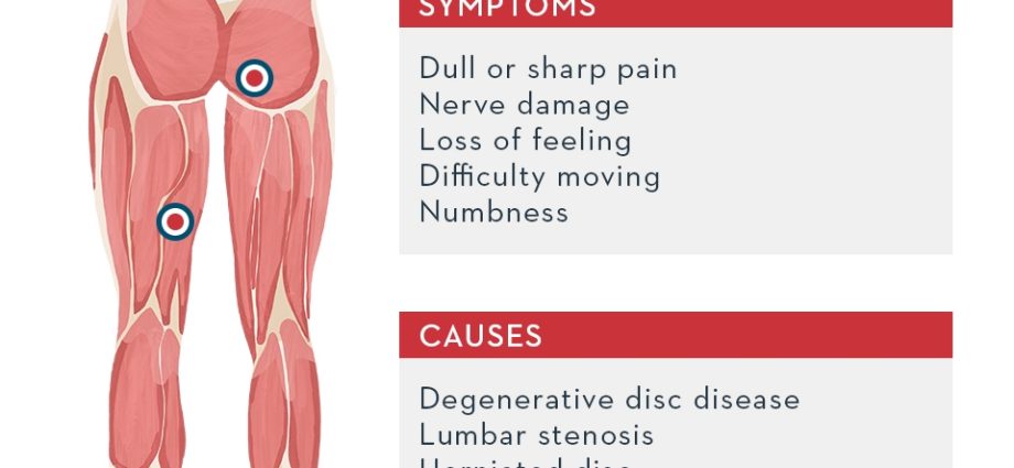 Sciatica &#8211; where does it come from? Causes, diagnosis, treatment