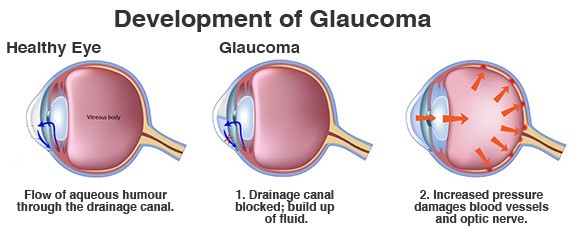 Scientists have discovered what contributes to the development of glaucoma