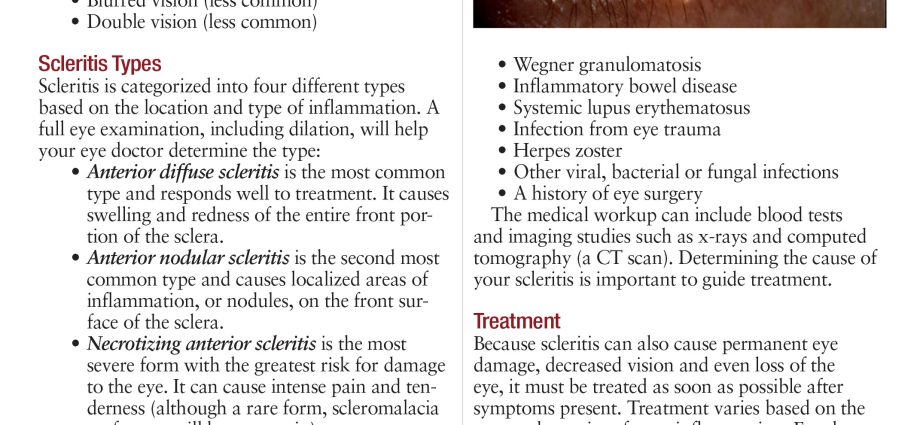 Scleritis &#8211; causes, symptoms, diagnosis and treatment