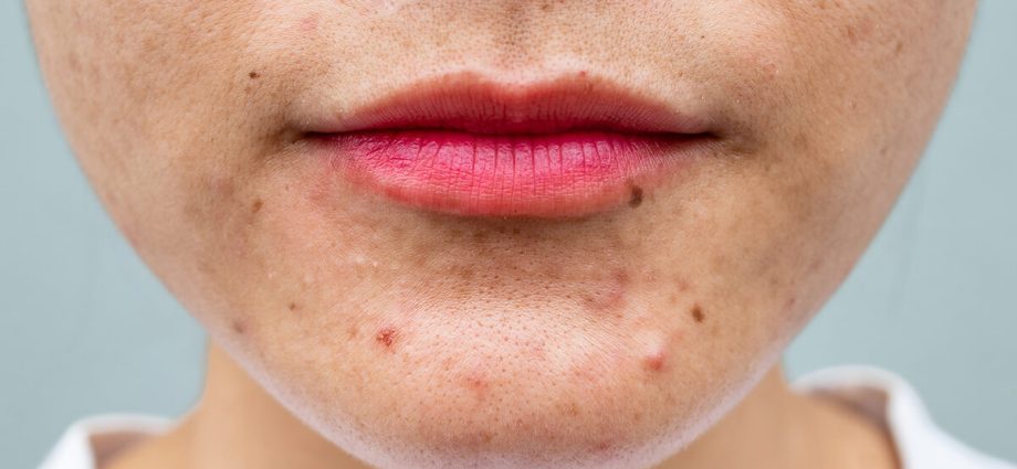 Sclerosing acne &#8211; symptoms, treatment and prognosis of the disease