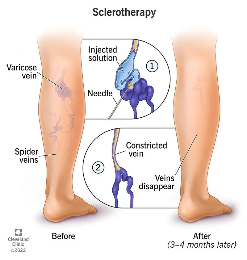 Sclerotherapy &#8211; what is it? When to use the treatment and what are the effects?