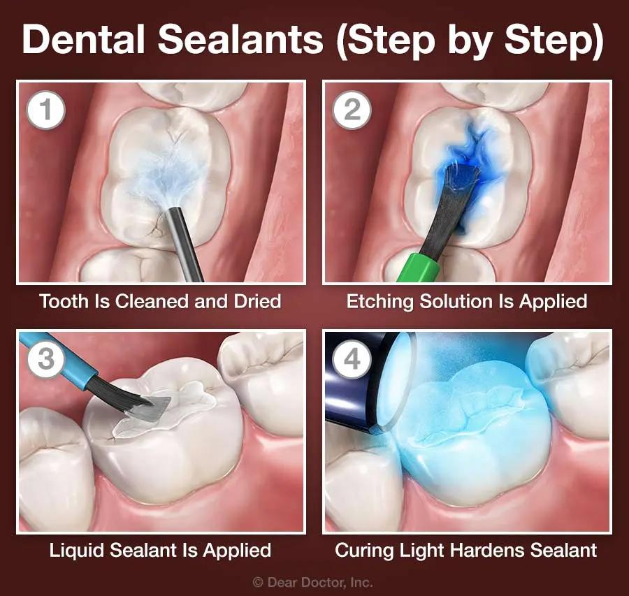 Sealing teeth