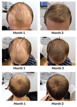 Seborrheic alopecia &#8211; symptoms and treatment