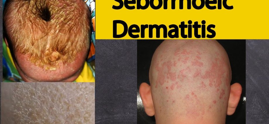 Seborrheic Dermatitis Causes Symptoms Treatment Who Is Most At Risk Of The Disease We