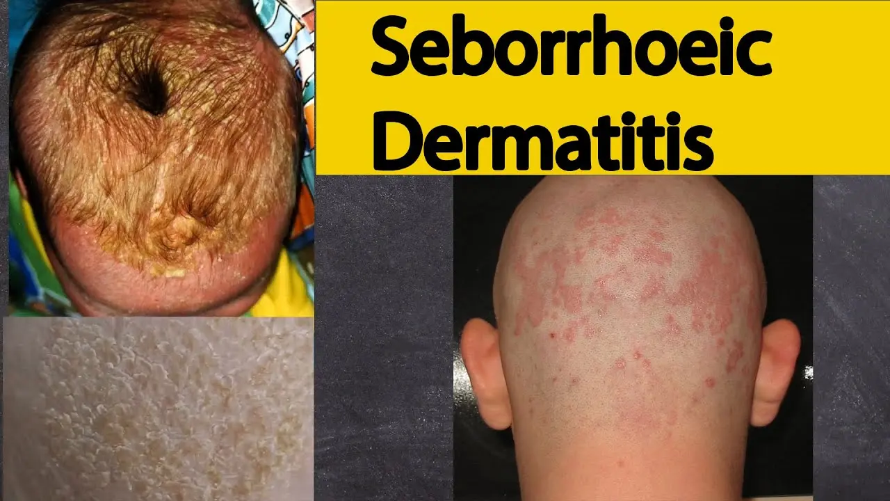 Seborrheic dermatitis &#8211; causes, symptoms, treatment. Who is most at risk of the disease? WE EXPLAIN