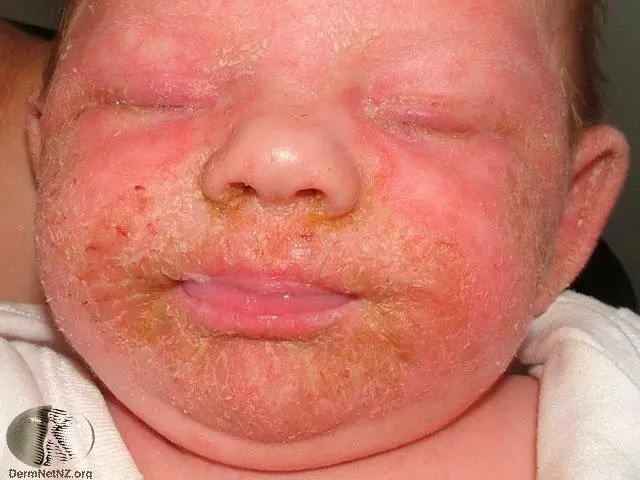 Seborrheic dermatitis in infants &#8211; symptoms, treatment