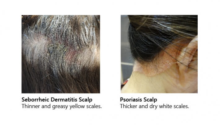 Seborrheic dermatitis or psoriasis?