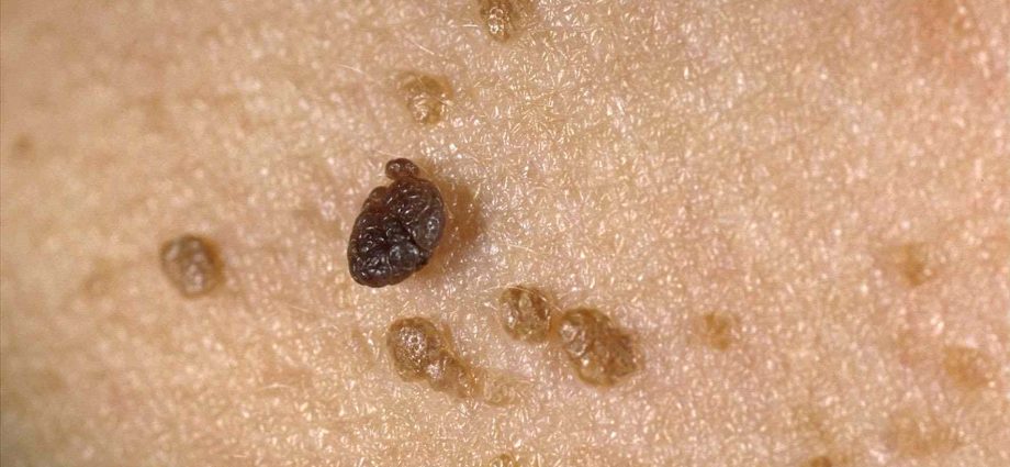 Seborrheic wart