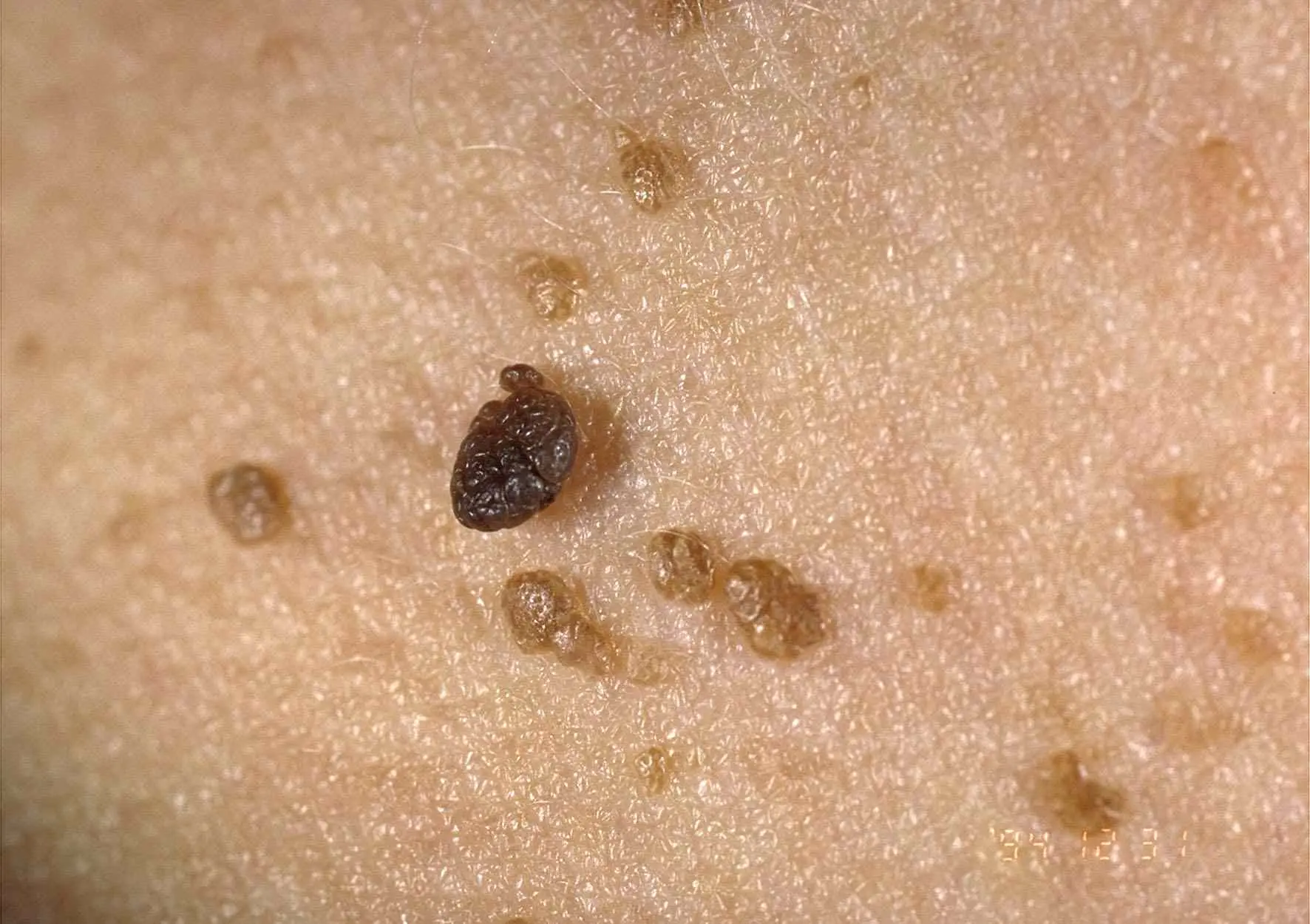 Seborrheic wart