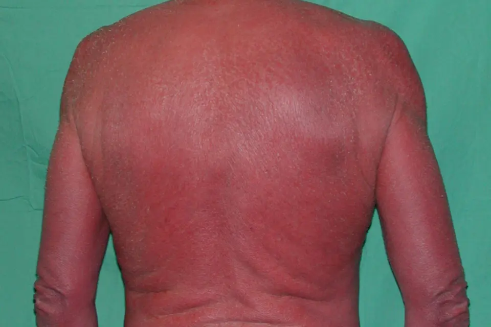 Secondary erythroderma &#8211; what is it?