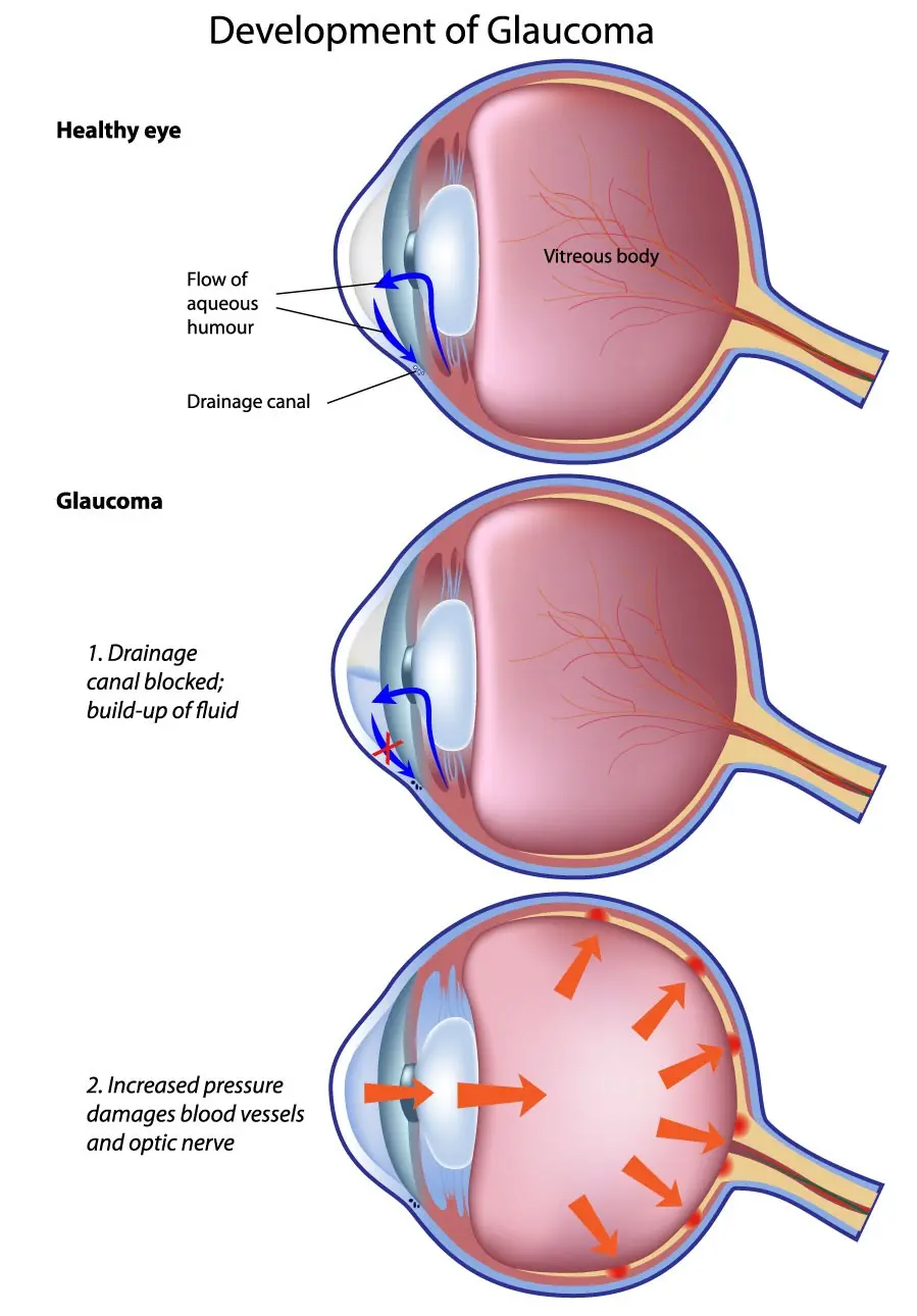 Secondary glaucoma