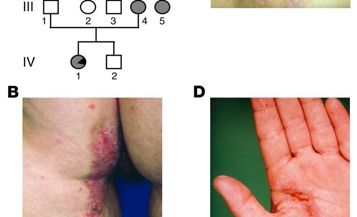 Segmental Hailey-Hailey disease