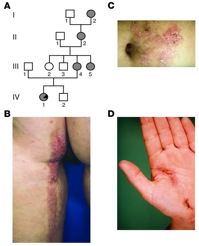 Segmental Hailey-Hailey disease