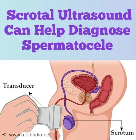 Seminal cyst (spermatocele) &#8211; causes of formation, methods of treatment