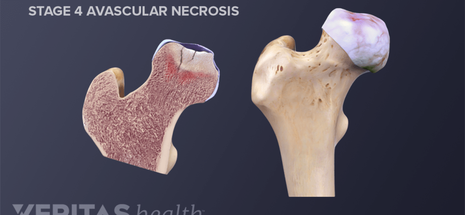 Separating necrosis in degeneration or necrosis of the joints. Causes and Treatment