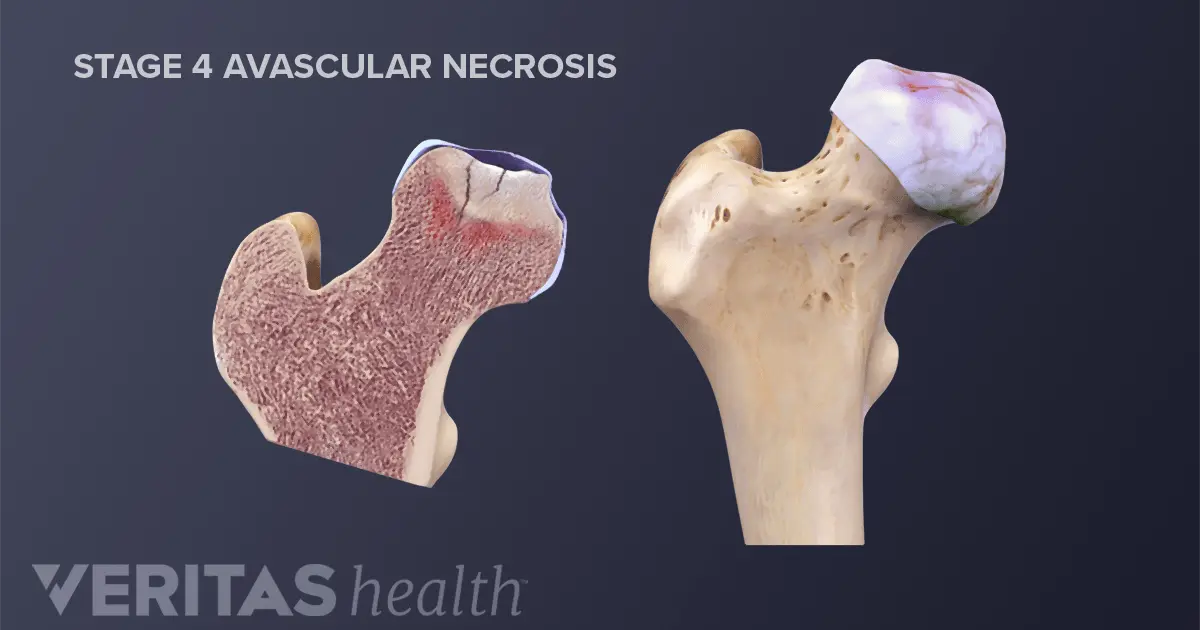 Separating necrosis in degeneration or necrosis of the joints. Causes and Treatment